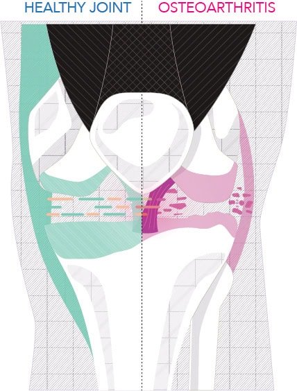 knee OA_1 knee OA_1