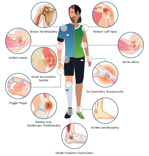 tendon injury examples tendon injury examples